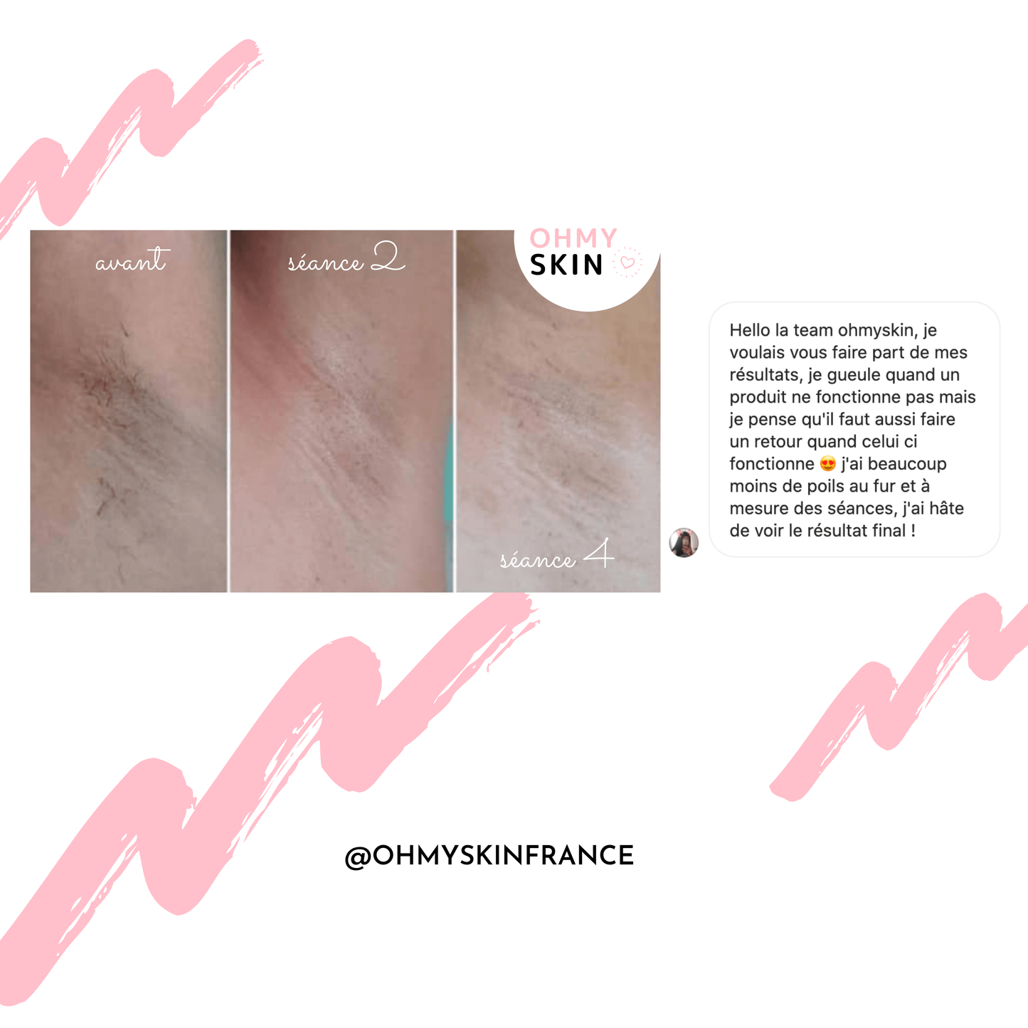 Ohmyskin Épilateur À Lumière Pulsée